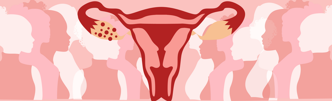 PCOS 101: What to Know & What to Do